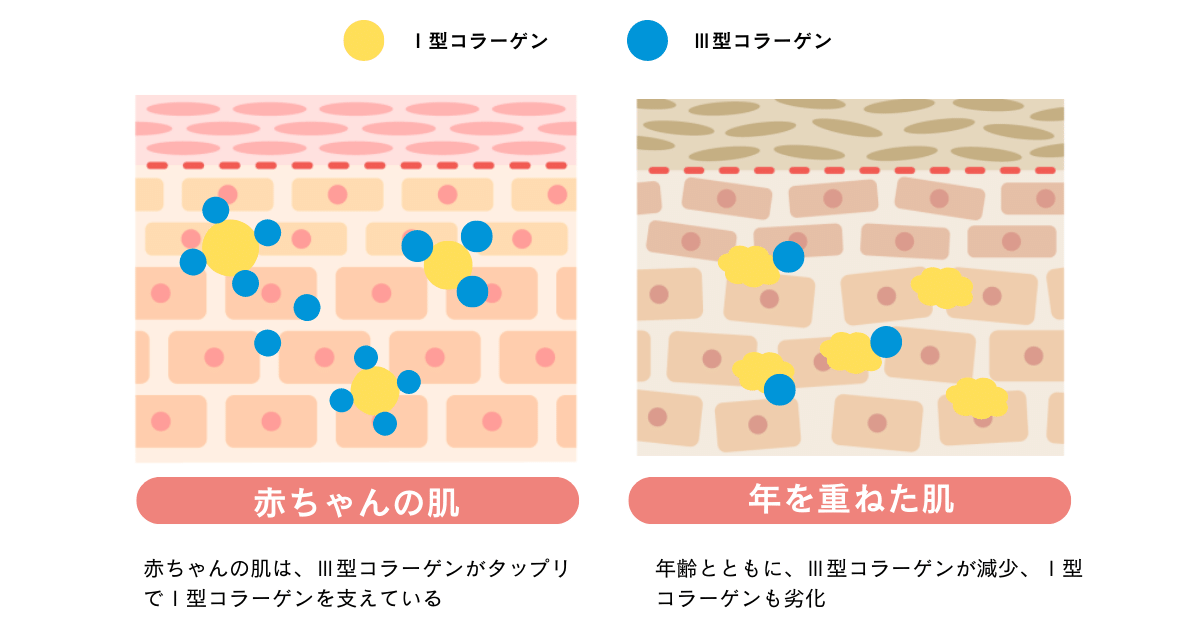 Ⅲ型コラーゲンサポート