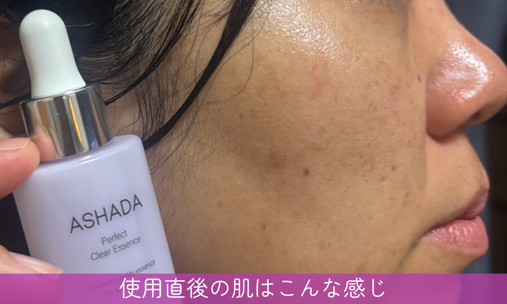 ASHADA(アスハダ)パーフェクトクリアエッセンスの使用後写真